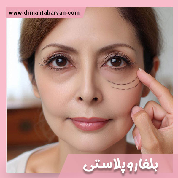 بلفاروپلاستی - دکتر مهتاب اشجع آروان