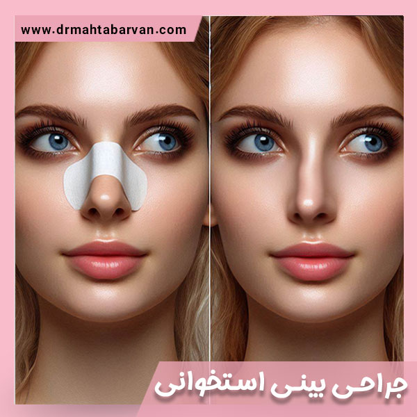 جراحی بینی استخوانی - دکتر مهتاب آروان