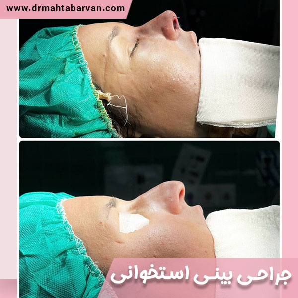 جراحی بینی استخوانی - دکتر مهتاب آروان