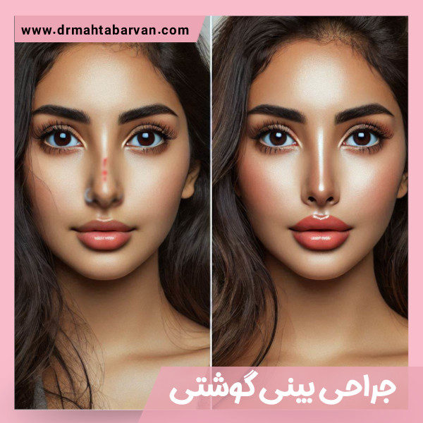 جراحی بینی گوشتی - دکتر مهتاب آروان