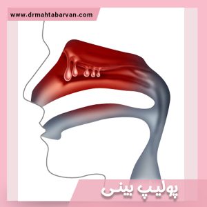 پولیپ بینی - دکتر مهتاب اشجع اروان